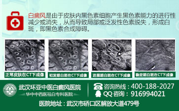 饮食不当会诱发白癜风吗 饮食不当会诱发白癜风吗