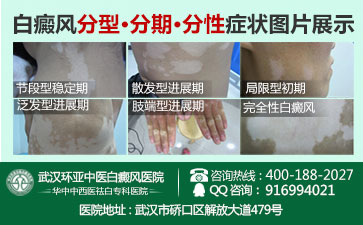 白癜风需要做什么检查 白癜风需要做什么检查