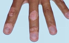 �ڶ��Ͱ����֢״������ʲô