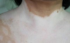 ���缲������ʲô֢״����