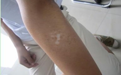 手臂白癜风的病因有哪些呢 手臂白癜风的病因有哪些呢