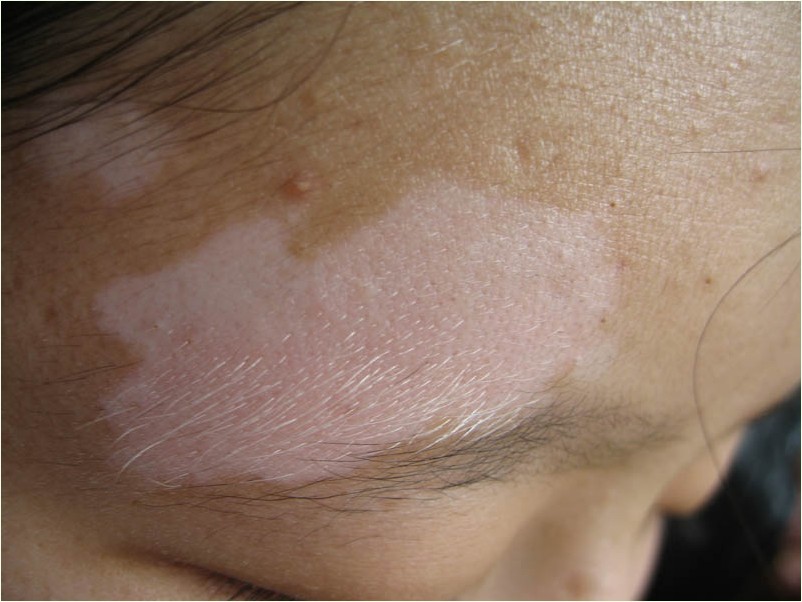 导致白癜风疾病常见的病因