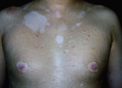 平常白斑不一定就是白癜风 平常白斑不一定就是白癜风