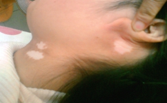 白癜风怎样治疗效果 白癜风怎样治疗效果