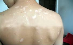 白癜风是什么原因形成的 白癜风是什么原因形成的