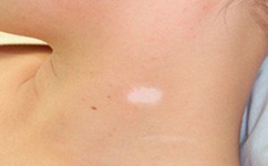 如何才能彻底的治愈白癜风 如何才能彻底的治愈白癜风