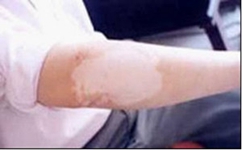 如何辨清白癜风症状特点 如何辨清白癜风症状特点