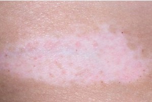 小孩白癜风在临床上都有哪些类型呢