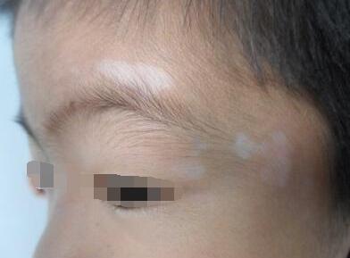 皮肤出现白块武汉白癜风医院哪家最好