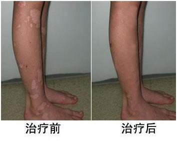 白斑患处发痒是为什么