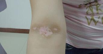 想更快治好白癜风,该怎么做