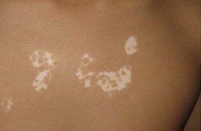 武汉早期轻度白癜风什么症状怎么治