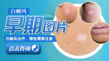 武汉白癜风发病初期有哪些症状