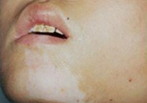 武汉白癜风是怎么引起的