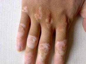 武汉白癜风有哪些症状呢