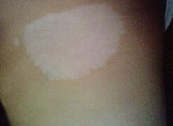 武汉白癜风早期症状与治疗