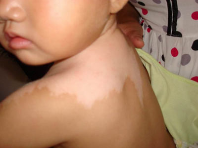 武汉白癜风的症状有哪些