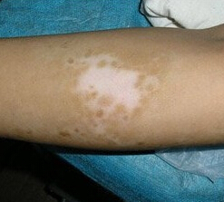 武汉白癜风初期症状特点有哪些