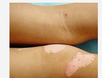 武汉引起白癜风的不良习惯有哪些