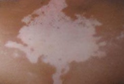 武汉什么原因导致白癜风出现