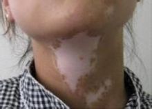 武汉白癜风如何进行早期诊断