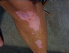 武汉白癜风对患者有哪些困扰