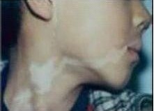 武汉小儿白癜风的危害有哪些