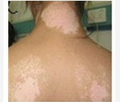 武汉白癜风不及时治疗的危害