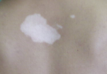 武汉白癜风的发病原因有哪些