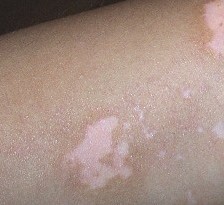 武汉了解白癜风初期治疗的注意事项