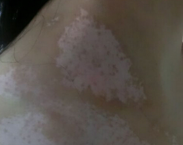 武汉白癜风如何进行治疗