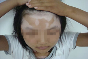 武汉女性治疗白癜风的正确方式