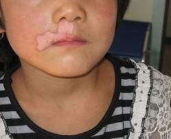 武汉女性早期白癜风有哪些表现