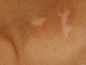 武汉青少年得了白斑怎么回事