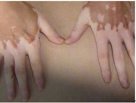 武汉临床上白癜风的诊断要点