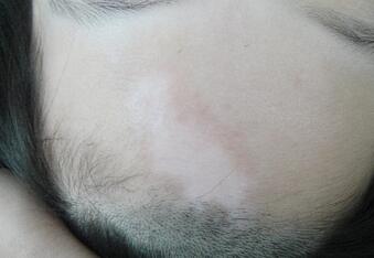 武汉白癜风预防方法有哪些