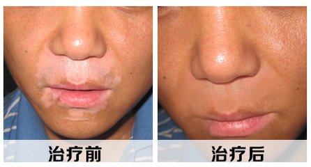 武汉年轻人白癜风发病特点
