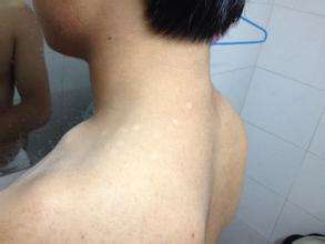 武汉小孩白癜风临床症状