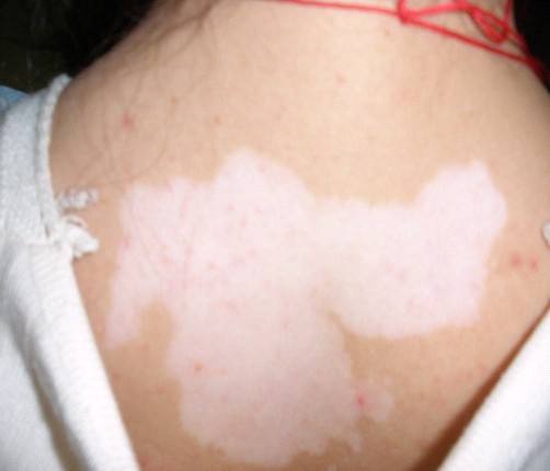 武汉女性早期白癜风症状