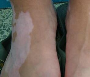 武汉白癜风的发病季节