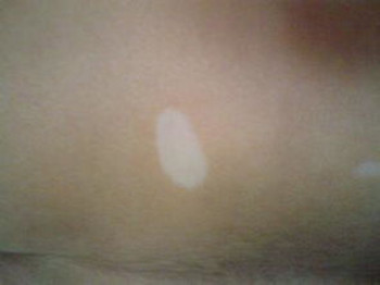 武汉治疗白癜风的有效方法具体有哪些