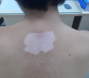 武汉白癜风的治疗应注意哪些事项