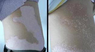 武汉小儿白癜风的危害