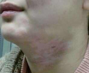 武汉白癜风确诊常用的办法