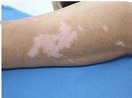 武汉早期白癜风症状特征