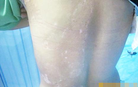 武汉女人白癜风早期特点