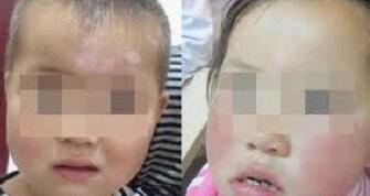 武汉儿童为什么会患上白癜风