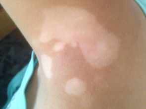 武汉女性患上白癜风的原因有什么