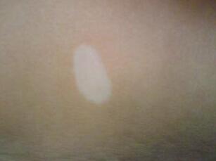 武汉女性白癜风的患病原因