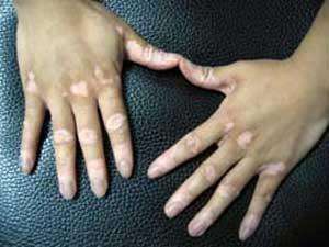 武汉青年白癜风预防方法有哪些